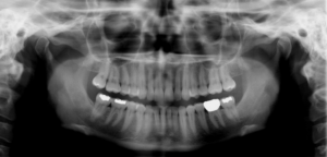 Temporomandibular X-Ray